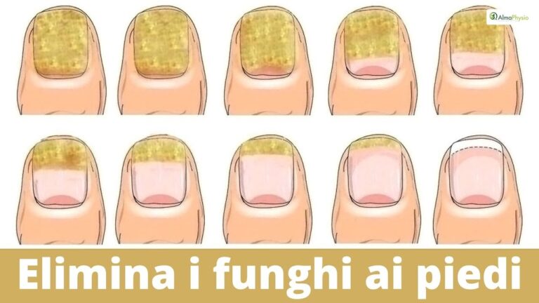 Recensioni su Onilaqare: Soluzione Efficace per Micosi Unghie