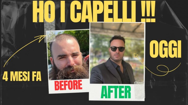 Recensioni sui Dermaroller per Capelli: Efficacia e Opinioni