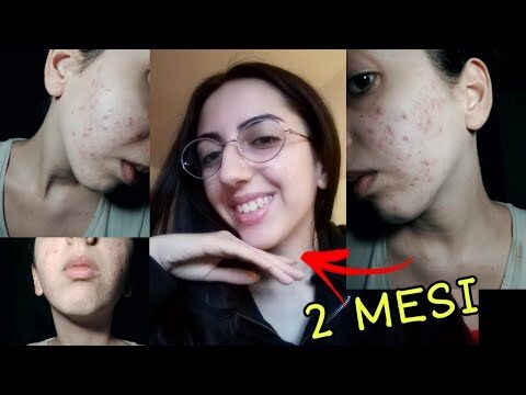 Recensioni su Clindamicina Gel: Efficacia e Opinioni