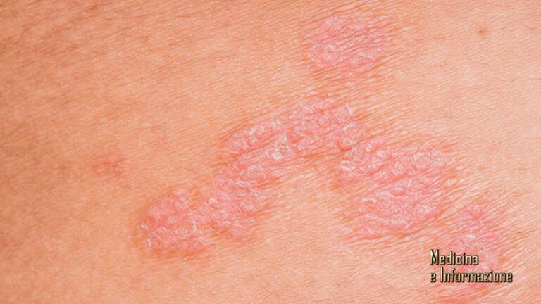 Flubason Crema Bustine: Efficacia e Utilizzo per la Salute della Pelle